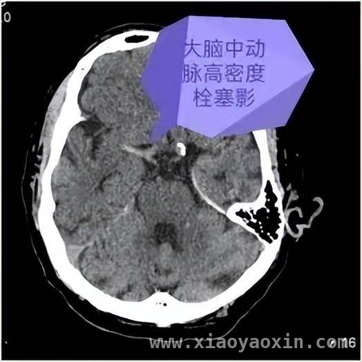 24 小时待命！醴陵市中医院神内二病区打响脑血管病救治战，醴陵市中医院神内二病区：用速度与专业为脑血管病患者撑起生命保护伞