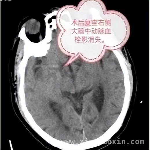 24 小时待命！醴陵市中医院神内二病区打响脑血管病救治战，醴陵市中医院神内二病区：用速度与专业为脑血管病患者撑起生命保护伞