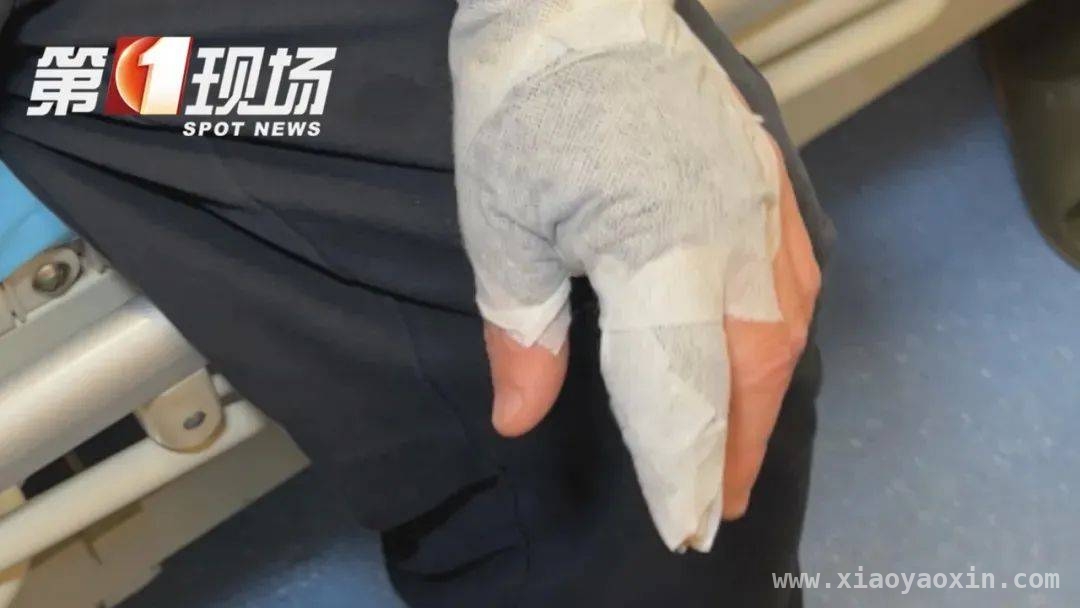 处理海鲜不当，男子竟因小伤口住院！这些要点要牢记