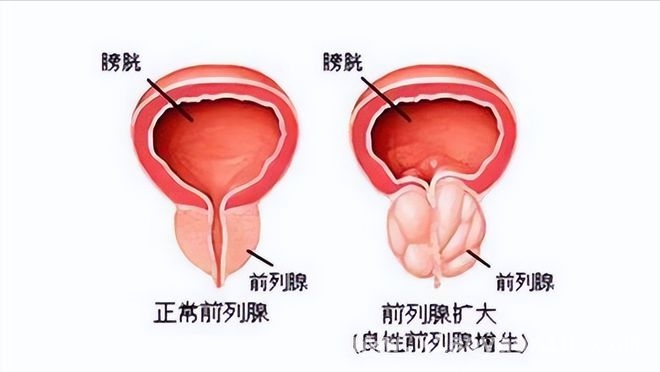别让前列腺肥大毁了你的生活，做好这些轻松预防！