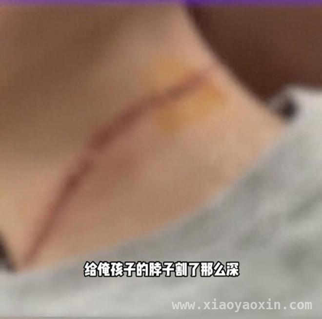 春日风筝暗藏危机，多起割伤事件敲响安全警钟，风筝线成“夺命凶器”，春日休闲如何保障安全？