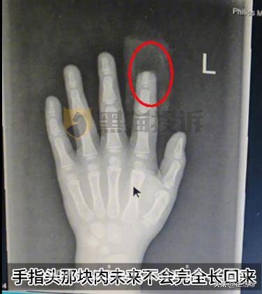 小鹏X9“防夹功能”缺失，儿童安全谁来守护？，小鹏X9伸缩支架惹祸，孩子断指索赔难上加难！