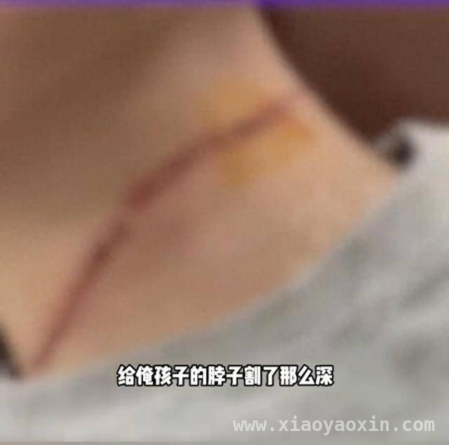 柔软风筝线竟成伤人利刃，多起悲剧为你敲响安全警钟！ 骑行途中频发割伤事故，风筝线“隐形杀手”有多可怕？
