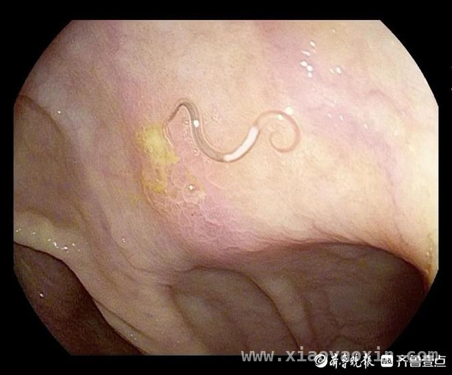 惊！男子体检竟在体内发现蠕动寄生虫