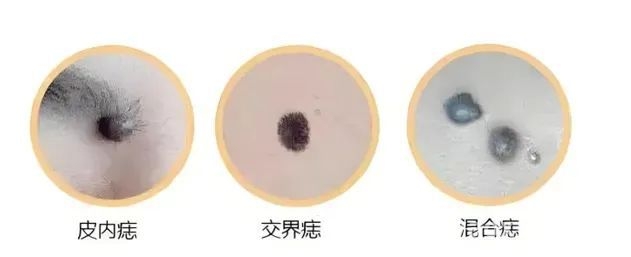 认识色素痣：辨别良恶性，守护健康防线