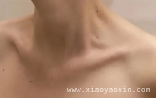 认识色素痣：辨别良恶性，守护健康防线