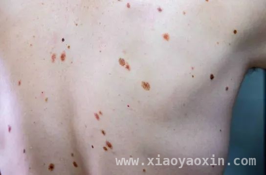 认识色素痣：辨别良恶性，守护健康防线