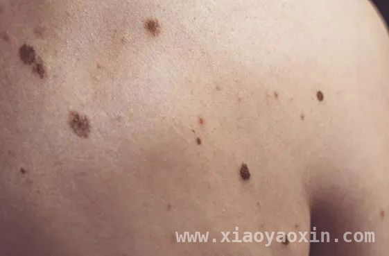 认识色素痣：辨别良恶性，守护健康防线