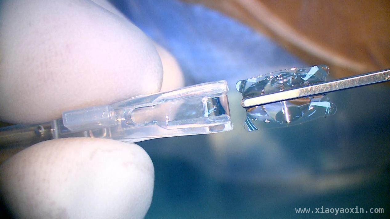 深圳首例国产“龙晶”晶体植入手术成功，近视矫正迎新突破