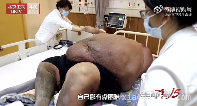 “中国第一胖”逆袭记：科学减重，重获健康人生，718.8斤“中国第一胖”逆袭，减重300斤开启新生活！